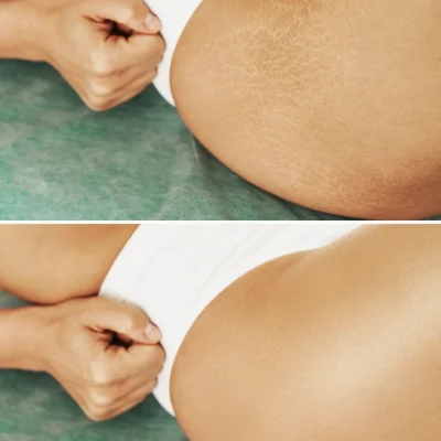closeup-female-hip-with-comparison-before-after-stretch-marks-treatment (1)